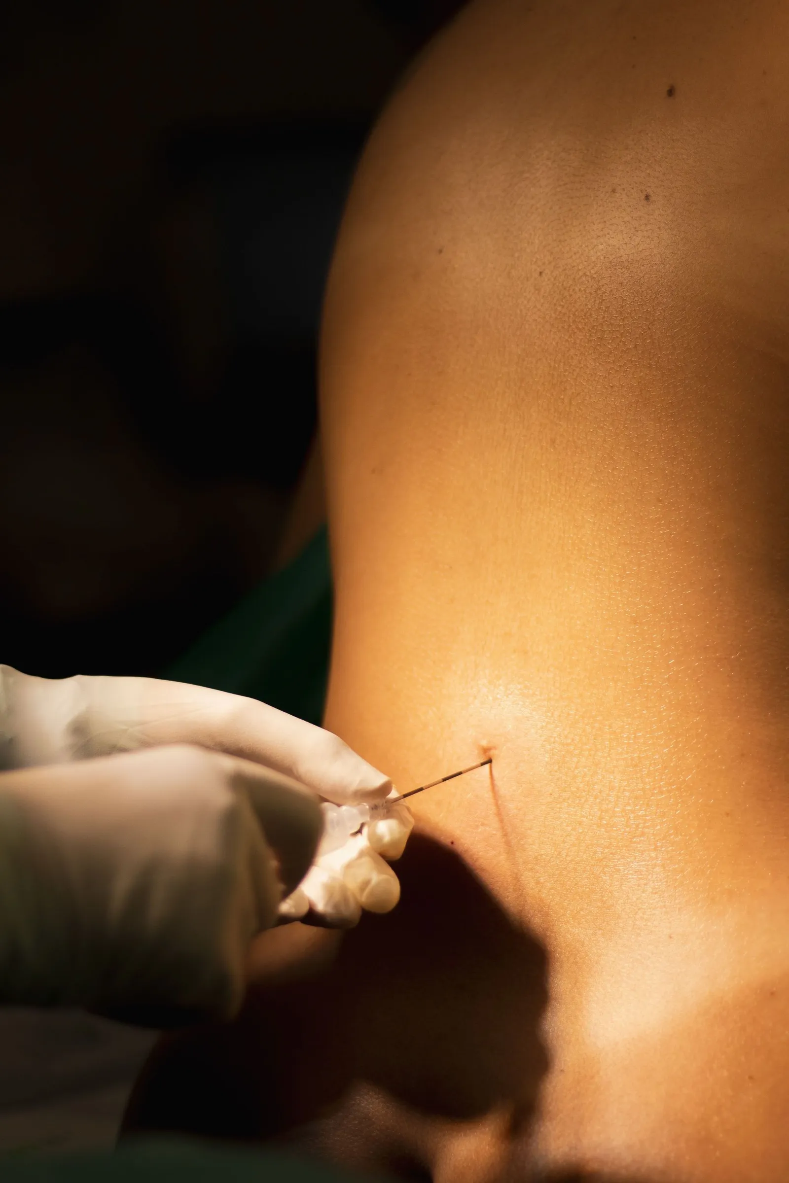 Liposuction
